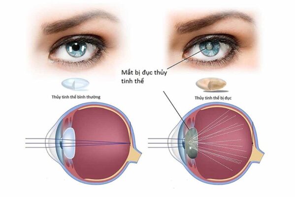 Chế độ ăn uống lành mạnh giúp giảm nhiều vấn đề về thị lực